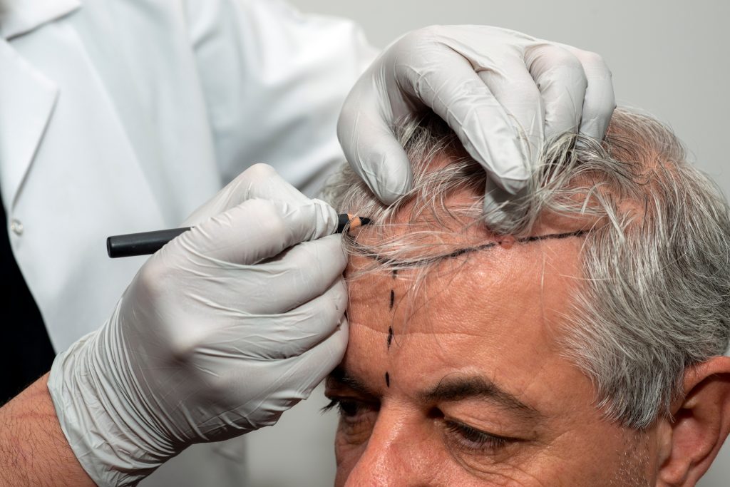 how much is a hair transplant in turkey